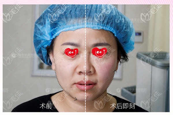 熱瑪吉做完左右臉即刻對(duì)比改善效果