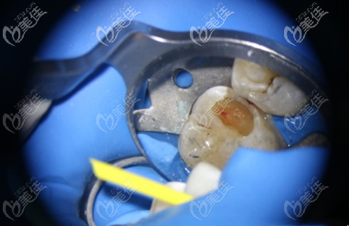 顯微根管治療下的牙齒情況