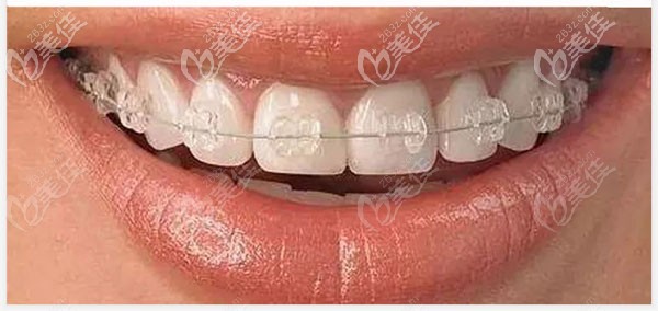 陶瓷牙齒矯正要多少錢