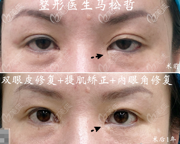 馬松哲醫(yī)生眼部修復案例 馬松哲醫(yī)生眼部修復案例