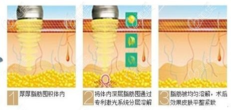 激光溶脂的原理