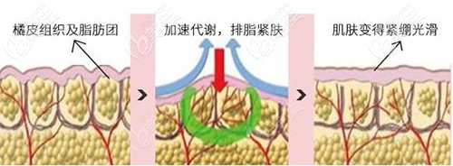 光纖溶脂緊膚的功效