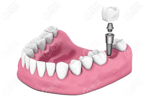 種植牙的效果怎么樣
