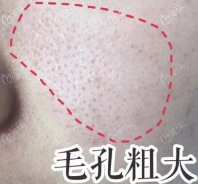 為什么做點陣激光6次縮毛孔沒效果