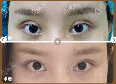 找的馬松哲醫(yī)生做的眼部修復案例 找的馬松哲醫(yī)生做的眼部修復案例