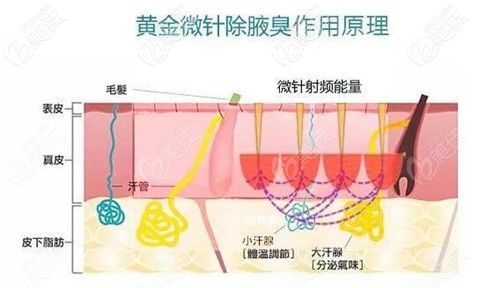 黃金微針去腋臭原理