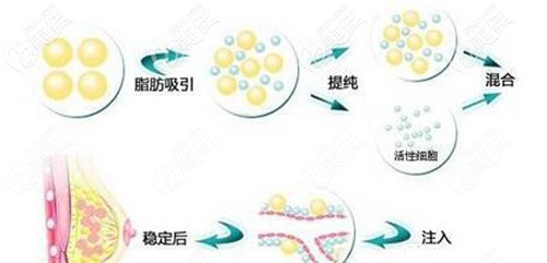 自體脂肪豐胸的過程