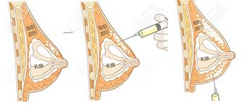 自體脂肪豐胸三次的效果
