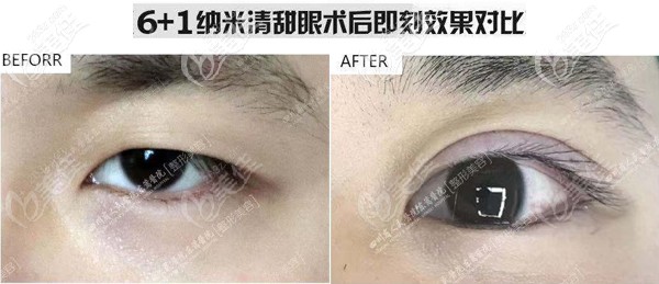 雙眼皮即刻和恢復(fù)后差別大嗎?來(lái)看看這張6+1納米清甜眼術(shù)后即刻對(duì)比效果圖