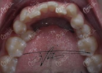 術(shù)前的齙牙也太丑了吧 術(shù)前的齙牙也太丑了吧