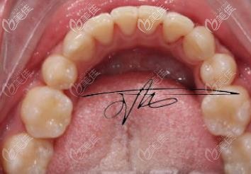 來看看齙牙的我找杭州雅萊齒科王龍院長做陶瓷牙套矯正的效果吧