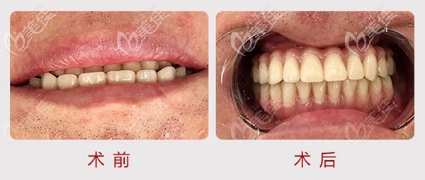 在廈門麥芽口腔做登騰ALL-on-6全口種植牙一年多后，張先生說：“比真牙還好用”！