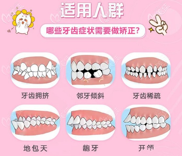廣州穗江矯正牙齒范圍 廣州穗江矯正牙齒范圍