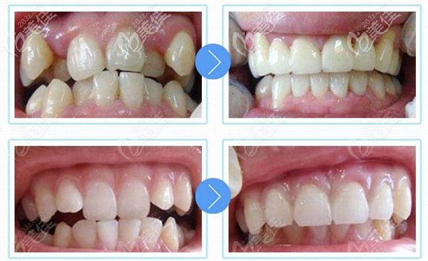 趙丹醫(yī)生金屬托槽矯正牙齒案例