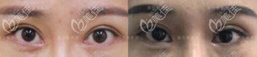 魏志香內(nèi)眼角修復(fù)前后對(duì)比照 魏志香內(nèi)眼角修復(fù)前后對(duì)比照