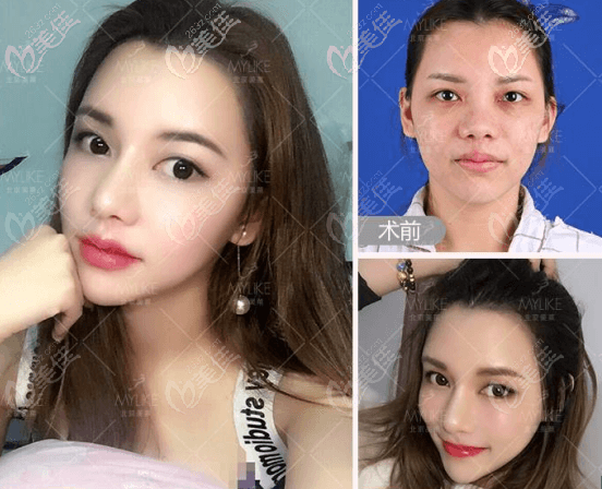 我找北京美萊董巖巖做的假體鼻綜合案例效果