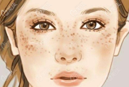 祛斑選擇超皮秒還是m22