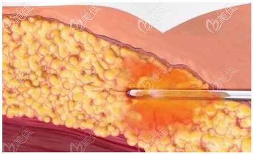 5g天使光雕吸脂過程 5g天使光雕吸脂過程