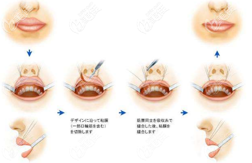 厚唇改薄手術(shù)