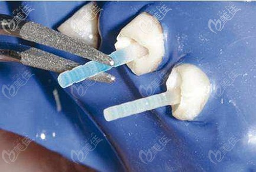 纖維樁是可以取出的 纖維樁是可以取出的