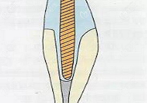 纖維樁的孔隙圖 纖維樁的孔隙圖