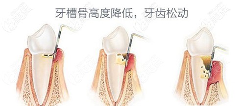 牙齒松動(dòng)的原因