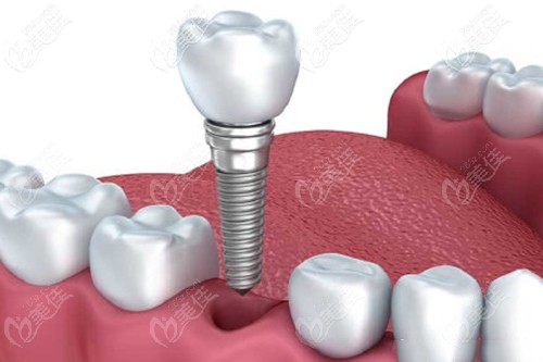 美格真種植牙的優(yōu)勢(shì)