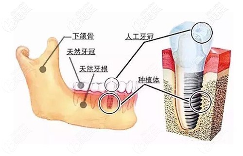 種植體能與牙槽骨貼合