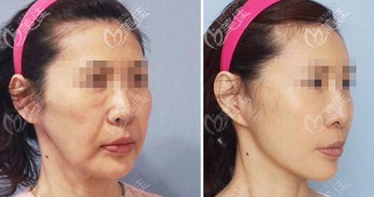 熱瑪吉+脂肪填充+埋線提升效果圖 熱瑪吉+脂肪填充+埋線提升效果圖