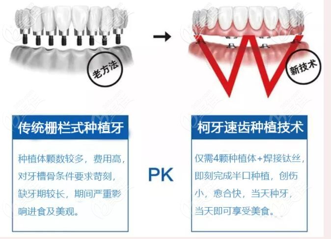 傳統(tǒng)種植牙和速齒技術(shù)區(qū)別 傳統(tǒng)種植牙和速齒技術(shù)區(qū)別