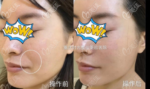 熱瑪吉去法令紋木偶紋效果圖 熱瑪吉去法令紋木偶紋效果圖