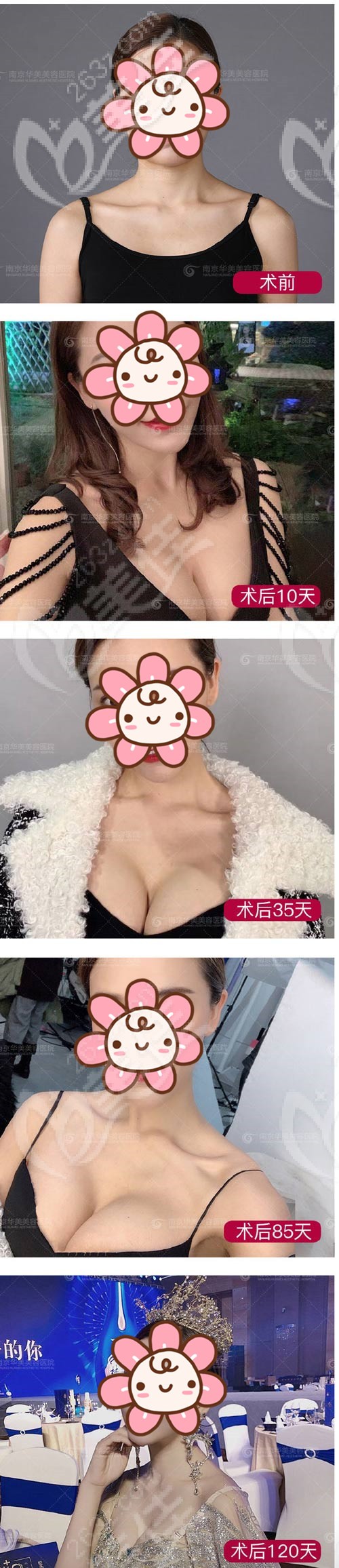 在南京華美做的蓓拉假體隆胸術(shù)前到術(shù)后 在南京華美做的蓓拉假體隆胸術(shù)前到術(shù)后