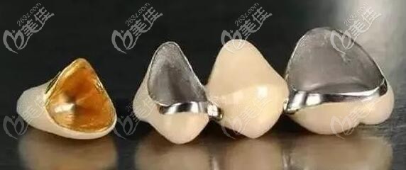 烤瓷冠中間是含金屬的，價格偏低