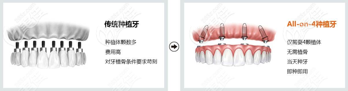 All-on-4種植牙技術(shù)優(yōu)點(diǎn)