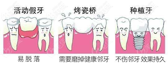 種植牙和鑲牙哪種好