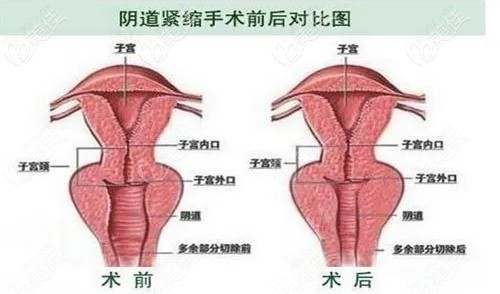 縮陰手術(shù)效果 縮陰手術(shù)效果