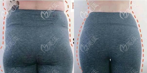 產(chǎn)后媽媽假胯寬做環(huán)吸抽脂效果對(duì)比圖