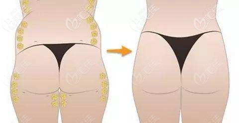 臀型吸脂劃分部位