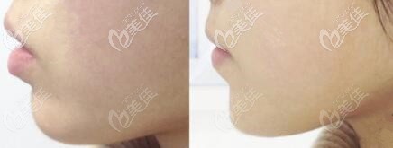 菲羽玻尿酸豐下巴真人前后對比照