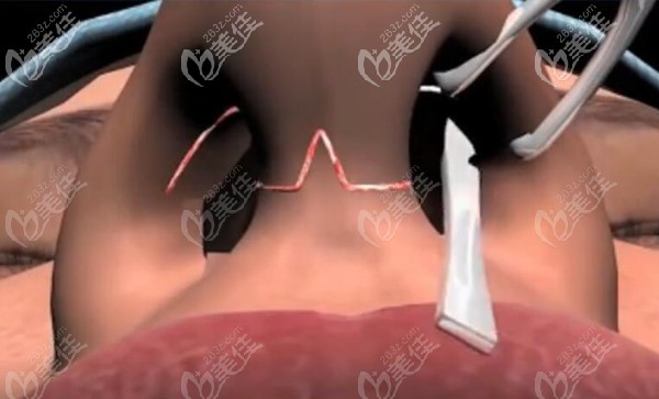 在鼻小柱做W型開放式切口
