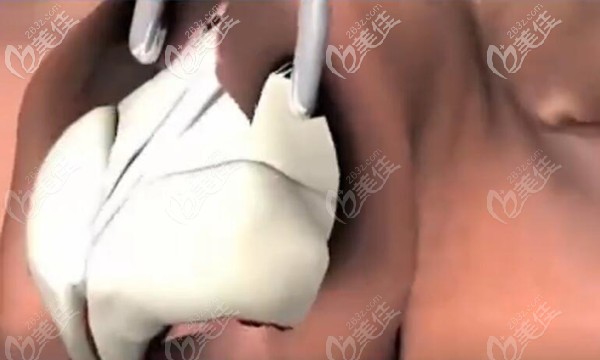 分離鼻骨與表面的骨膜肌肉、皮膚等