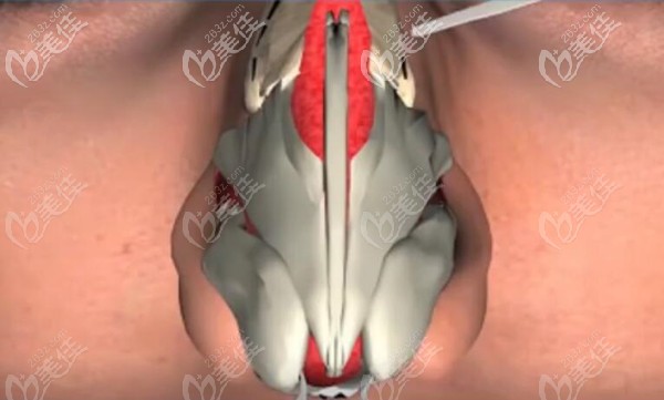 將鼻面交界處將上頜骨額突鋸斷