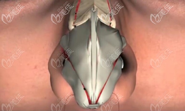 切除鼻翼軟骨后的效果
