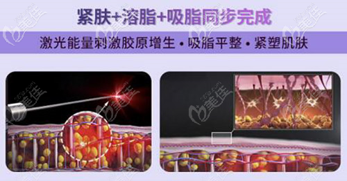 5g天使光雕集緊膚+溶脂+吸脂同步進(jìn)行