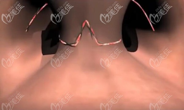 將鼻子縫合結(jié)束寬鼻矯正手術(shù)