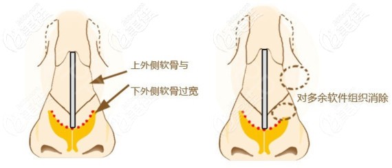 寬鼻矯正手術(shù)原理示意圖