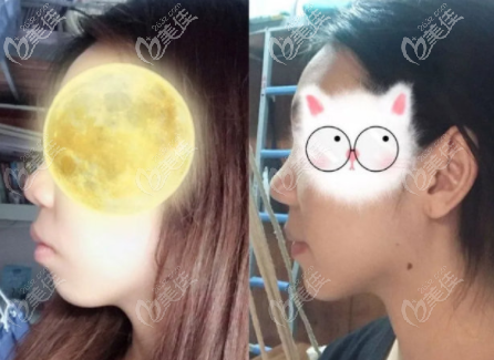 美立刻隱形矯正案例