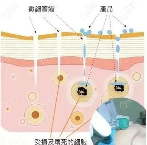 微針美膚的原理