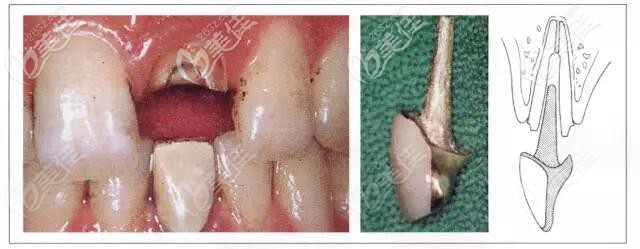 樁冠修復(fù) 樁冠修復(fù)