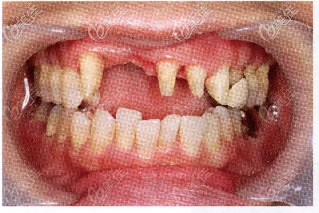 牙齒缺失 牙齒缺失